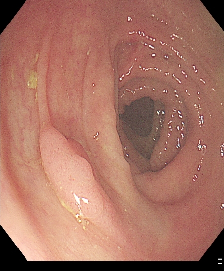 为什么说热活检钳​肠息肉切除术的一般步骤，5张图片教会你_https://www.jmylbn.com_新闻资讯_第14张