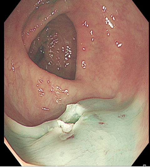 为什么说热活检钳​肠息肉切除术的一般步骤，5张图片教会你_https://www.jmylbn.com_新闻资讯_第17张