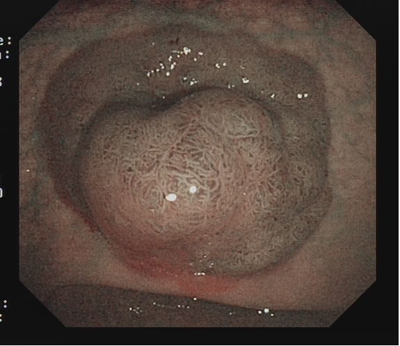 为什么说热活检钳​肠息肉切除术的一般步骤，5张图片教会你_https://www.jmylbn.com_新闻资讯_第20张