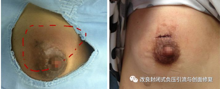 VSD怎么更换引流瓶简易封闭式负压引流：操作流程细节，视频配解说_https://www.jmylbn.com_新闻资讯_第10张