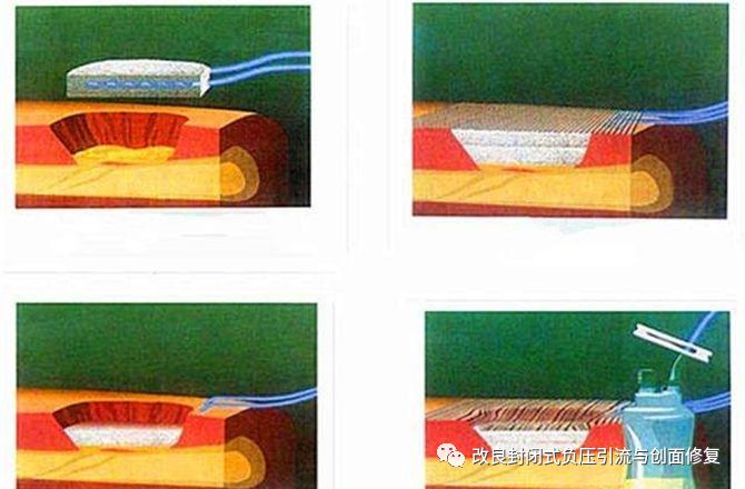 VSD怎么更换引流瓶简易封闭式负压引流：操作流程细节，视频配解说_https://www.jmylbn.com_新闻资讯_第1张