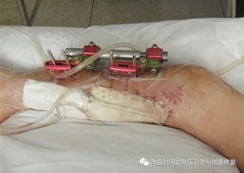 VSD怎么更换引流瓶简易封闭式负压引流：操作流程细节，视频配解说_https://www.jmylbn.com_新闻资讯_第2张