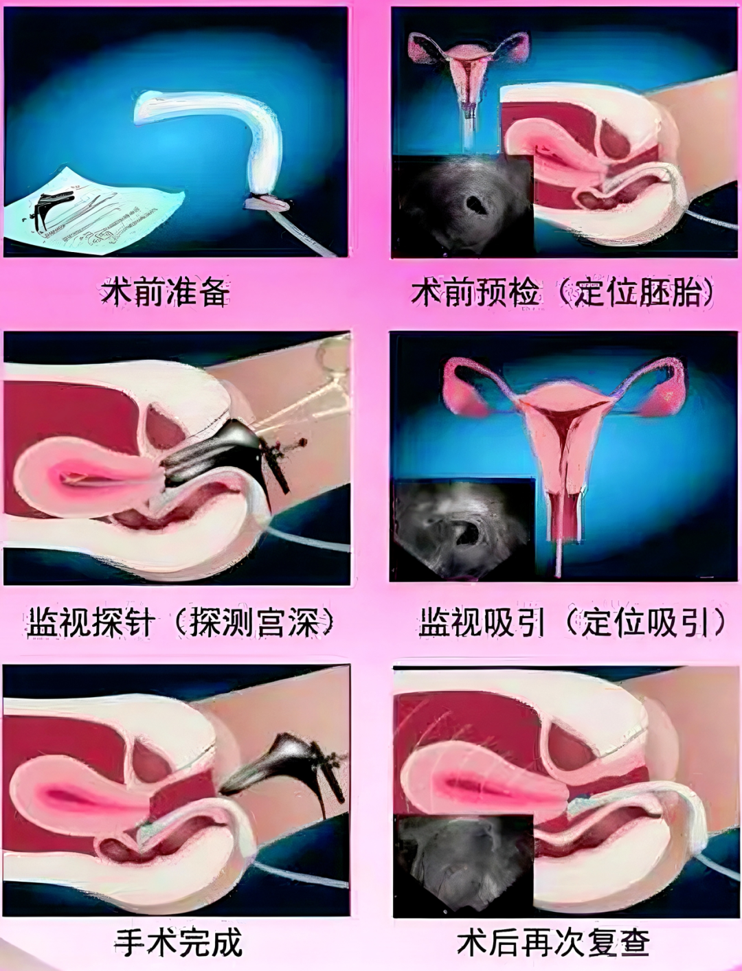 超声引导人流是什么【健康科普】什么是超声引导下可视化人流_https://www.jmylbn.com_新闻资讯_第6张