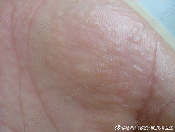 手上起水疱特别痒?