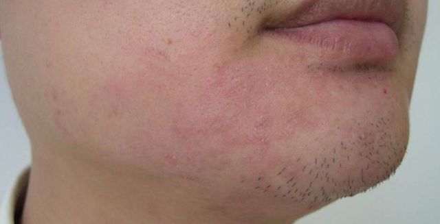 难辩认癣反常的"青春痘",要小心"艾滋病"痤疮样皮损皮肌炎的特征性