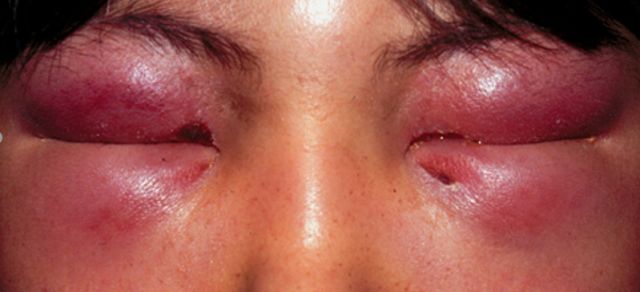 眼睑水肿性红斑有"摧花蝴蝶"之称系统性红斑狼疮的典型表现,蝶形红斑