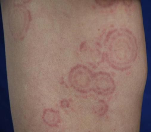 体癣图片_体癣初期症状图片_儿童体癣图片