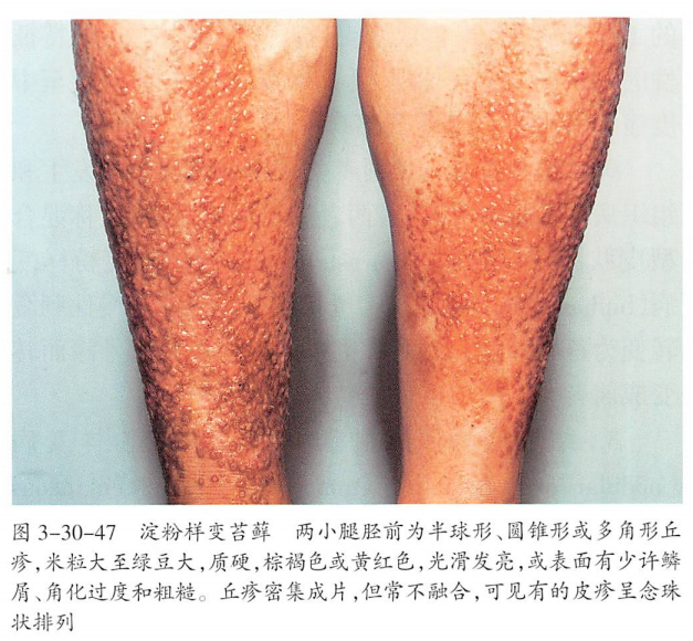 原发性皮肤淀粉样变病的特征是皮肤损害和真皮内淀粉样蛋白沉积,根据