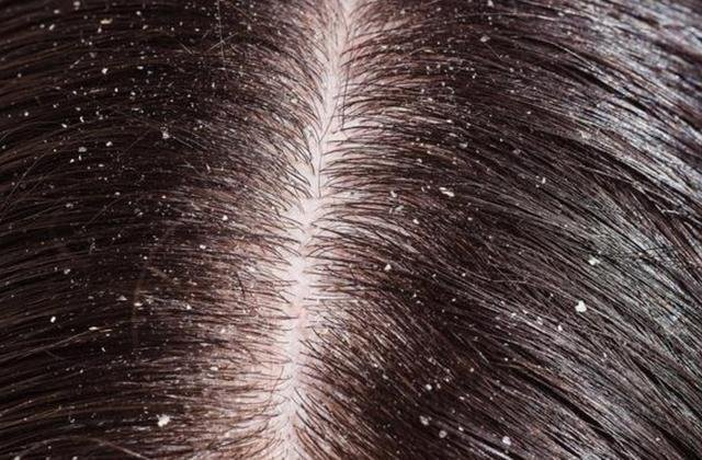 因此,白色颗粒显然跟薄片状的头皮屑有很大区别,大部分人还是可以凭