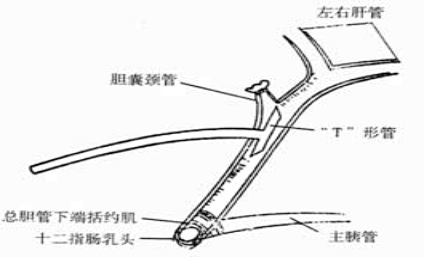 引流袋怎么开胆总管切开取石术后T管的管理指南_https://www.jmylbn.com_新闻资讯_第6张