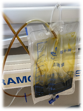 引流袋怎么开胆总管切开取石术后T管的管理指南_https://www.jmylbn.com_新闻资讯_第13张