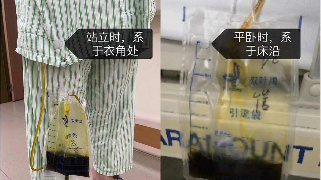 引流袋怎么开胆总管切开取石术后T管的管理指南_https://www.jmylbn.com_新闻资讯_第12张