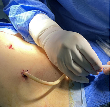 引流袋怎么开胆总管切开取石术后T管的管理指南_https://www.jmylbn.com_新闻资讯_第10张