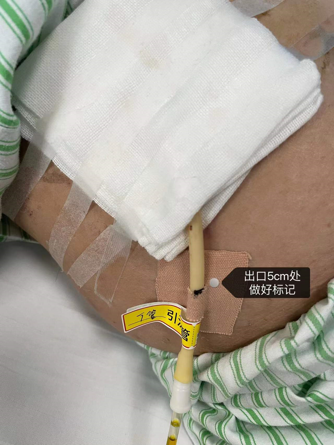 引流袋怎么开胆总管切开取石术后T管的管理指南_https://www.jmylbn.com_新闻资讯_第11张