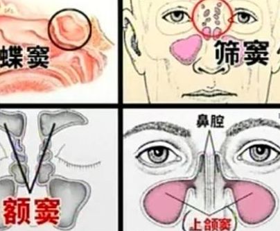 鼻窦炎到底因何而起？
