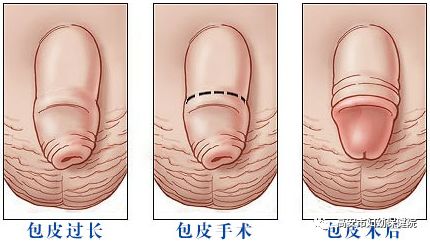 包皮包茎手术正当时 高安市妇幼保健院 微信公众号文章阅读 Wemp