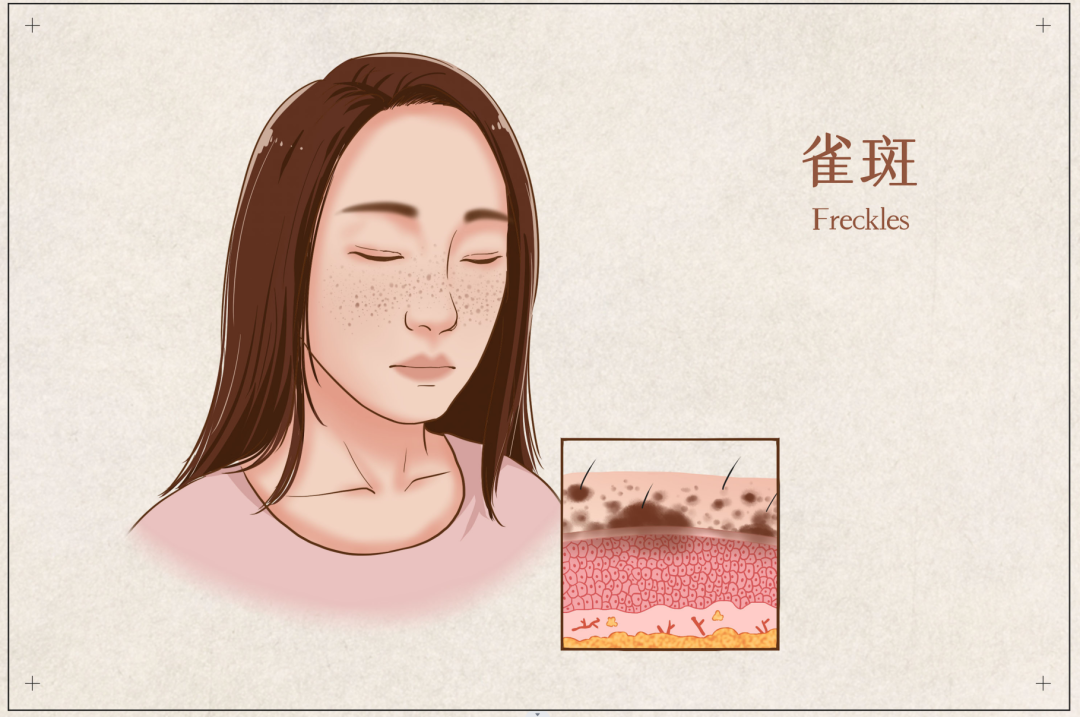 脸上斑块长不停？多因血虚又血瘀！一个中药方，活血化瘀消斑