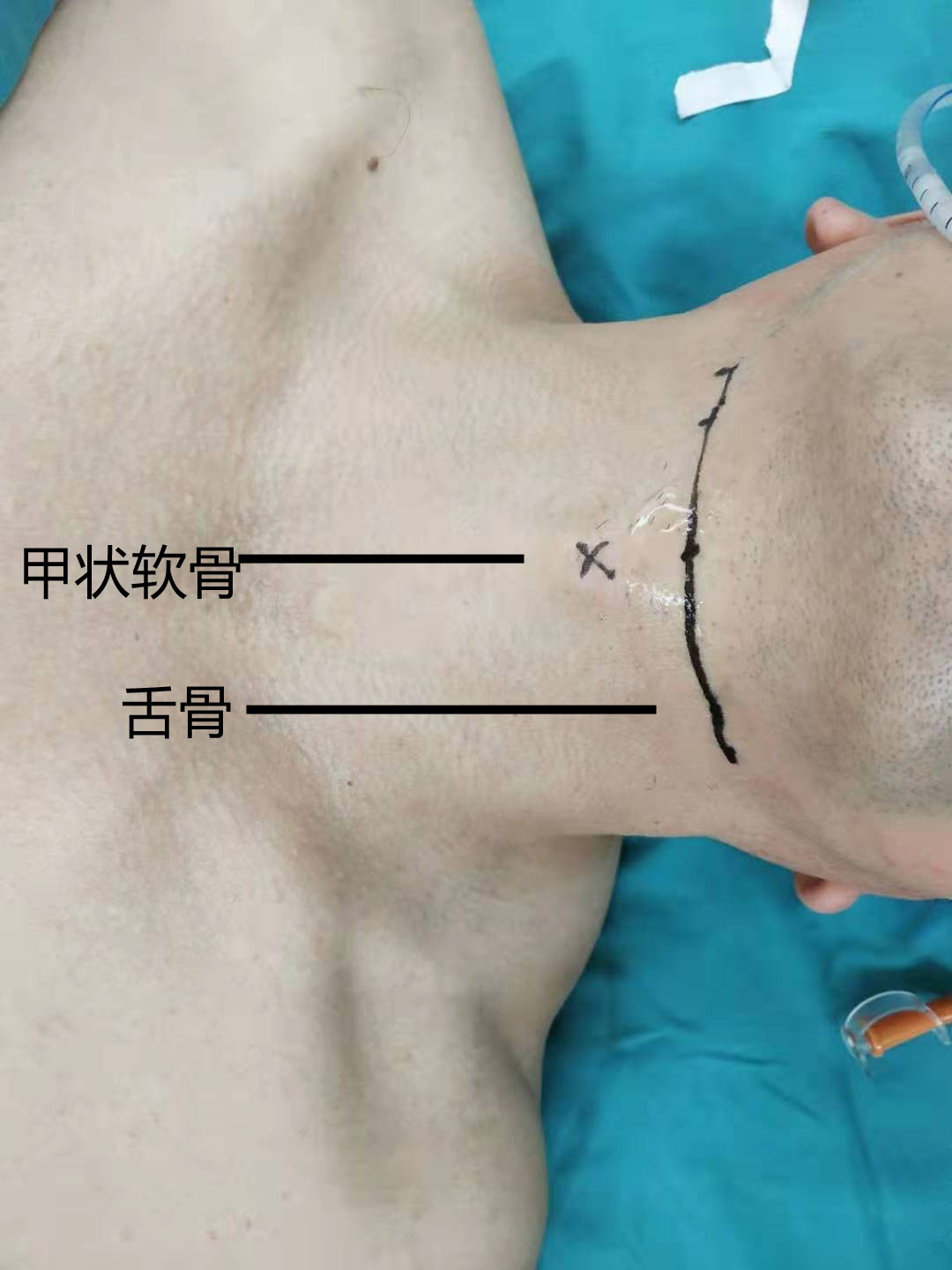环甲膜穿刺的位置图示图片