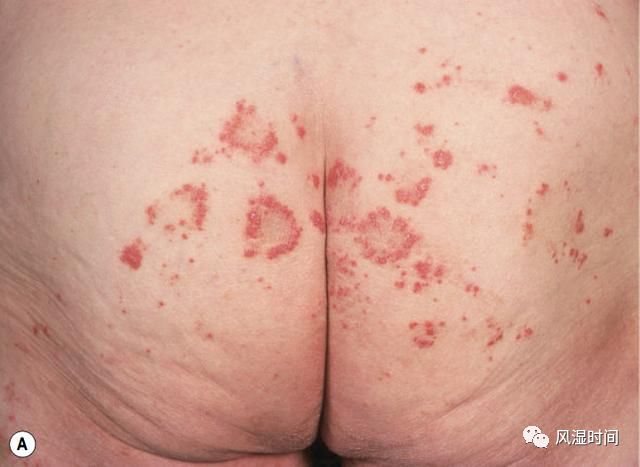 面板紫癜各不同_腎內時間- 微文庫