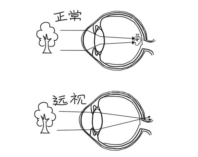 遠視是人眼看到的物體成像在視網膜的後方.