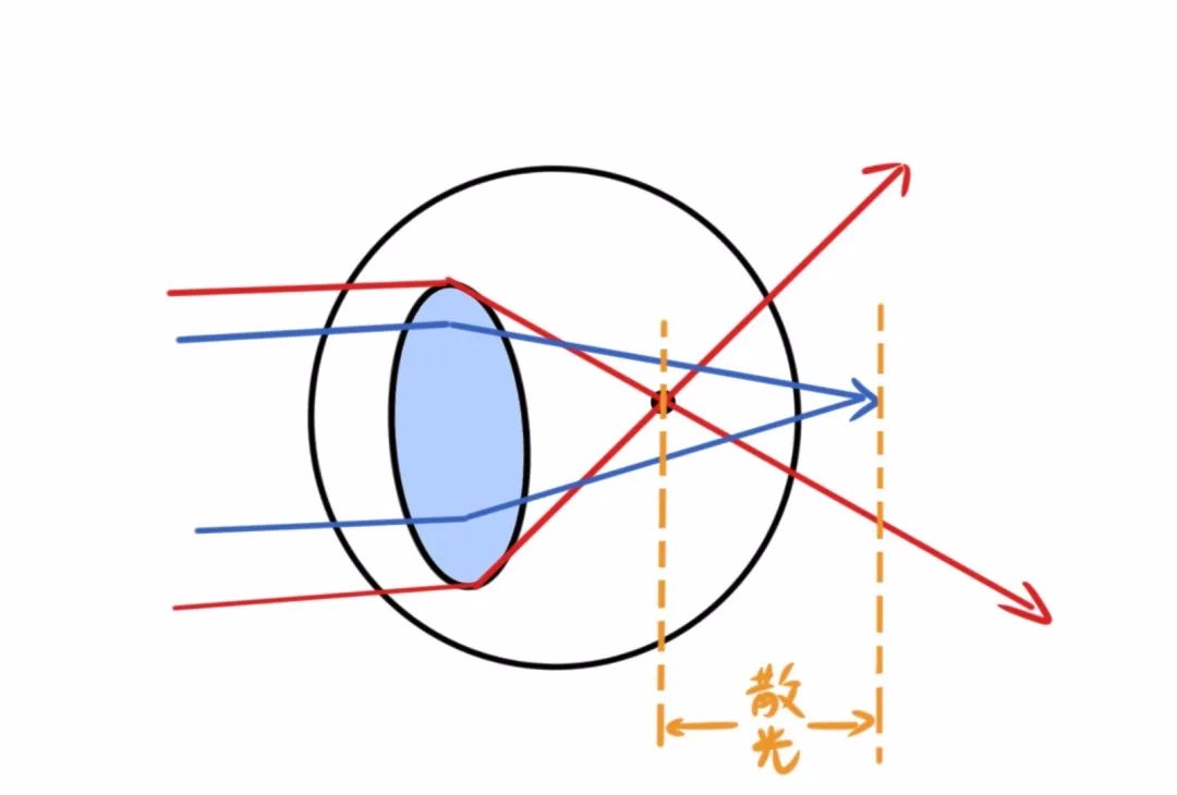 孩子有散光需要戴眼镜吗
