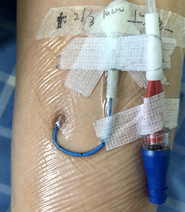 中心静脉导管是什么肿瘤化疗的“生命线”：PICC、PORT、中心静脉导管CVC分别是什么？_https://www.jmylbn.com_新闻资讯_第2张