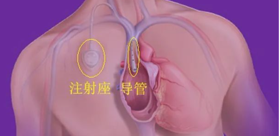 中心静脉导管是什么肿瘤化疗的“生命线”：PICC、PORT、中心静脉导管CVC分别是什么？_https://www.jmylbn.com_新闻资讯_第4张