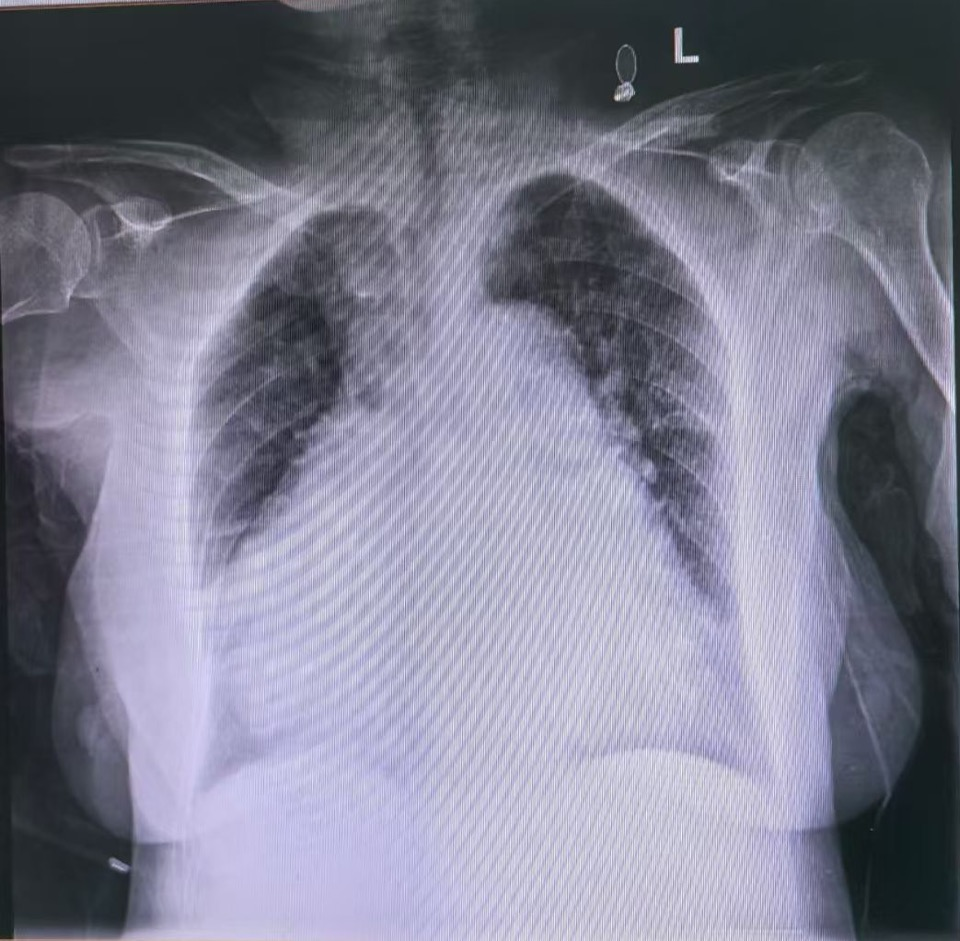 心脏是怎么固定的【学科技术】南昌市第一医院成功开展螺旋主动固定式无导线心脏起搏器植入术_https://www.jmylbn.com_新闻资讯_第3张