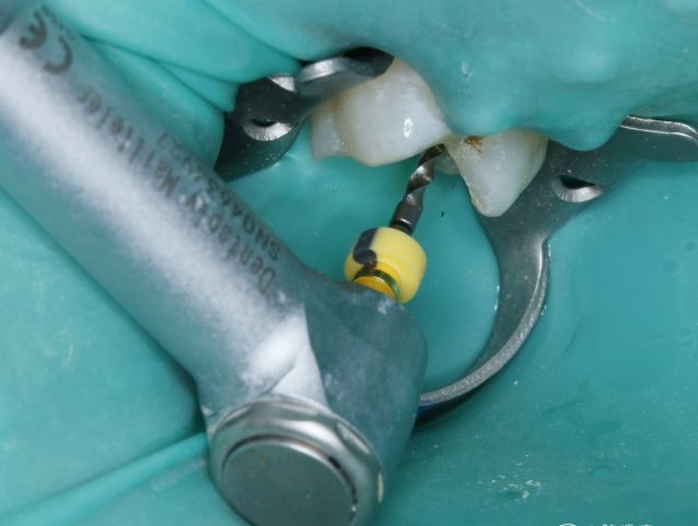 为什么要用根管马达【牙医必备】机扩使用说明、注意事项大全！_https://www.jmylbn.com_新闻资讯_第2张