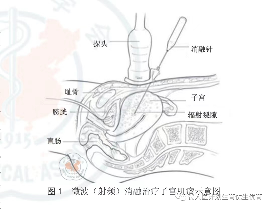 妇科微波治疗怎么做创新!微波消融术用于治疗子宫动静脉瘘_新闻资讯_第5张_活检穿刺产品网 妇科微波治疗怎么做创新!微波消融术用于治疗子宫动静脉瘘_https://www.jmylbn.com_新闻资讯_第5张