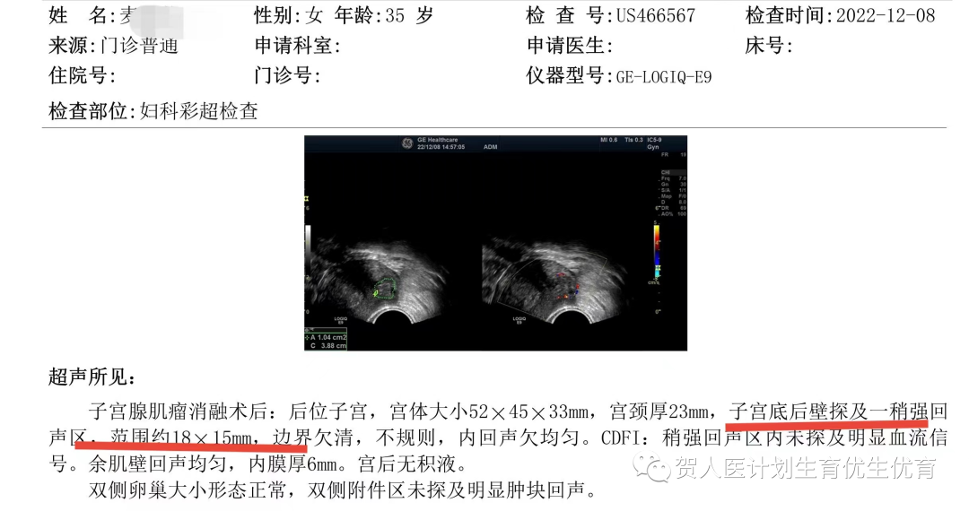 妇科微波治疗怎么做创新！微波消融术用于治疗子宫动静脉瘘_https://www.jmylbn.com_新闻资讯_第10张