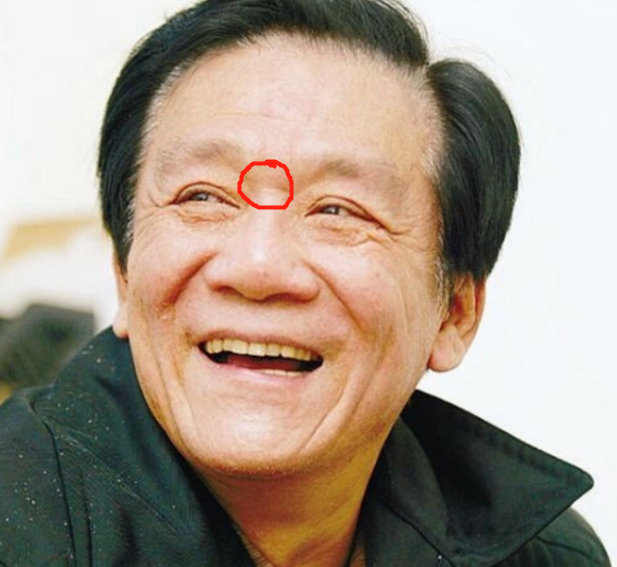 一,看鼻上横纹在这种情况下,人体血液循环加快,心脏负荷加重,容易诱发