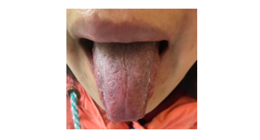 舌質黯紫舌底有淤絡的要注意了，不調理，可能會得腫瘤、心梗、不孕、中風。。。 健康 第4張