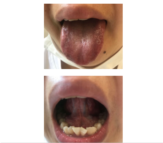 舌質黯紫舌底有淤絡的要注意了，不調理，可能會得腫瘤、心梗、不孕、中風。。。 健康 第3張