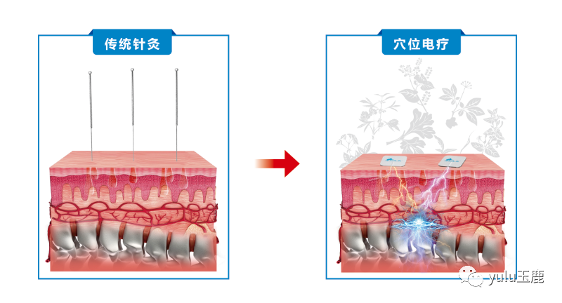 中频为什么能镇痛收藏：关于中频电疗非常客观的一篇科普文章_https://www.jmylbn.com_新闻资讯_第9张