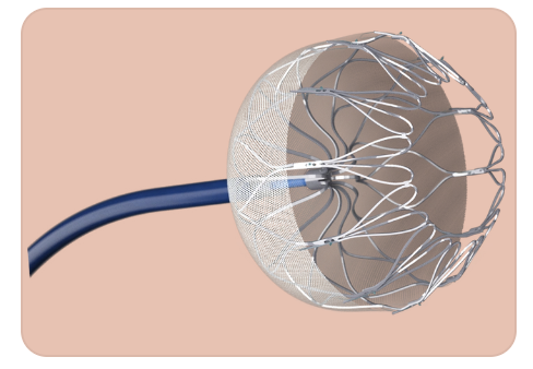 什么是介入耗材盘点介入医学中有哪些植入耗材？_https://www.jmylbn.com_新闻资讯_第8张