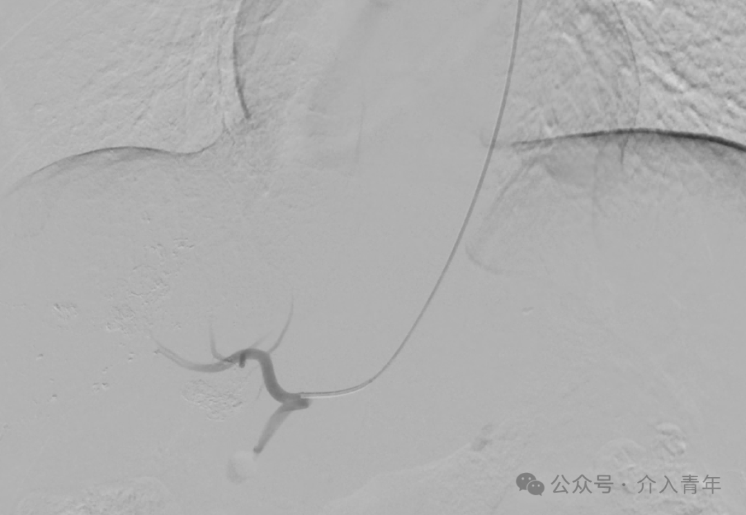 桡动脉鞘怎么读手把手教你如何做单微导管HAIC_https://www.jmylbn.com_新闻资讯_第7张