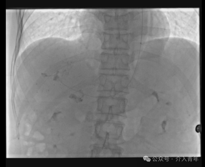 桡动脉鞘怎么读手把手教你如何做单微导管HAIC_https://www.jmylbn.com_新闻资讯_第9张