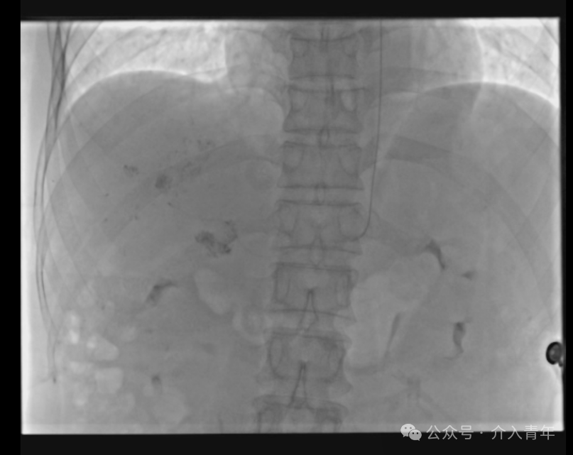 桡动脉鞘怎么读手把手教你如何做单微导管HAIC_https://www.jmylbn.com_新闻资讯_第10张