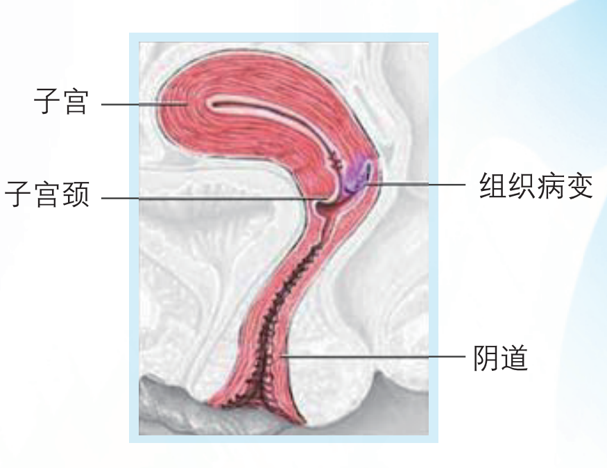 912针是什么姐妹们，打针了没？预防宫颈癌是我们的大事！-上海聚慕医疗器械有限公司