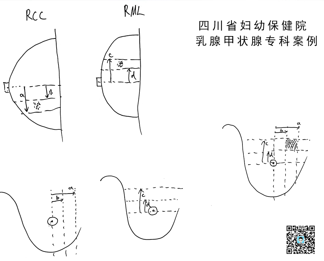 怎么制造手术钩针看医生如何精准“钩出”乳腺钙化灶，将早期乳腺癌“绳之以法”_https://www.jmylbn.com_新闻资讯_第2张