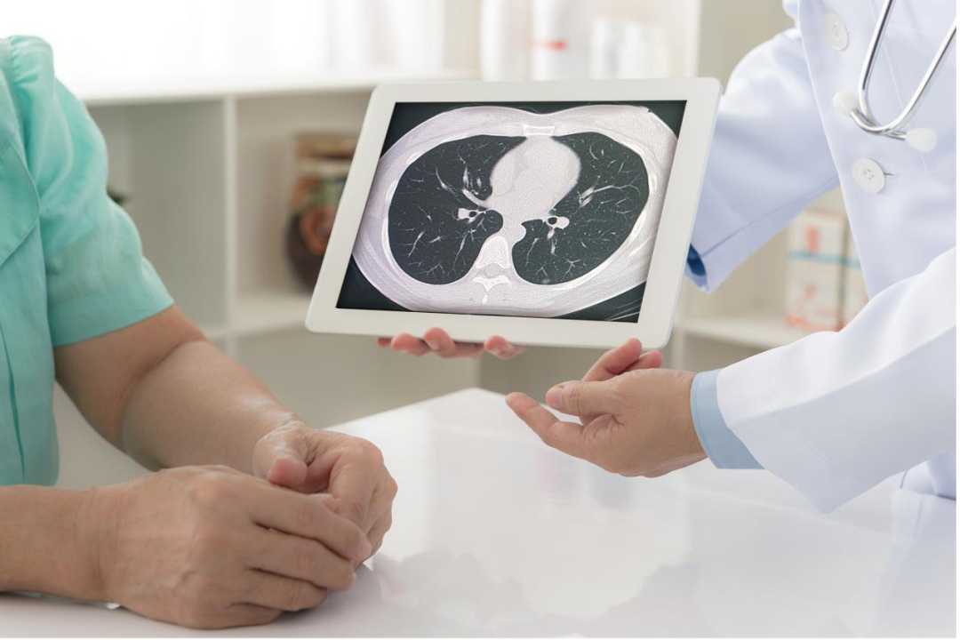 肺部结节 肺部结节