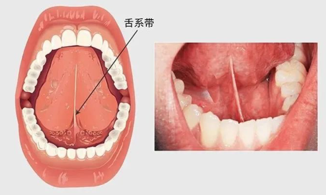 激光和电刀区别是什么为什么要剪舌系带？_https://www.jmylbn.com_新闻资讯_第8张