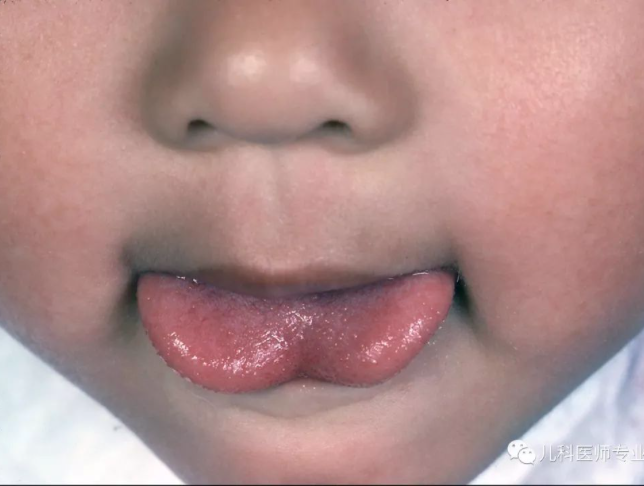 激光和电刀区别是什么为什么要剪舌系带？_https://www.jmylbn.com_新闻资讯_第11张