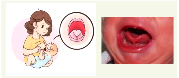 激光和电刀区别是什么为什么要剪舌系带？_https://www.jmylbn.com_新闻资讯_第4张