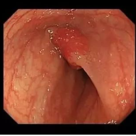 电子直肠镜怎么做CT也能做“肠镜”了！？ 不用插管！不用脱裤子_https://www.jmylbn.com_新闻资讯_第5张