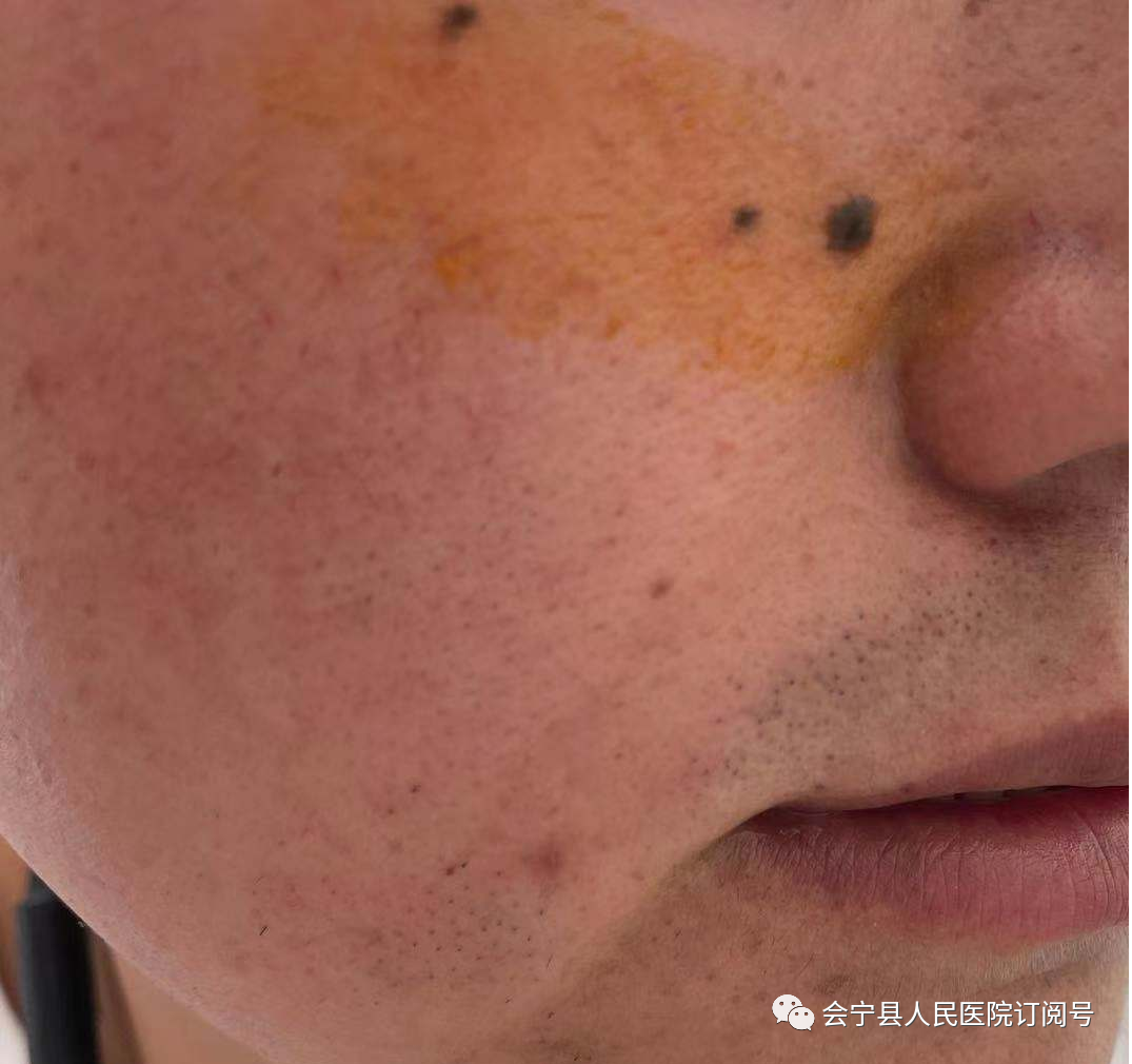 微波治疗机怎么使用【医学科普】微波手术治疗机可以治疗哪些常见皮肤病？_https://www.jmylbn.com_新闻资讯_第5张