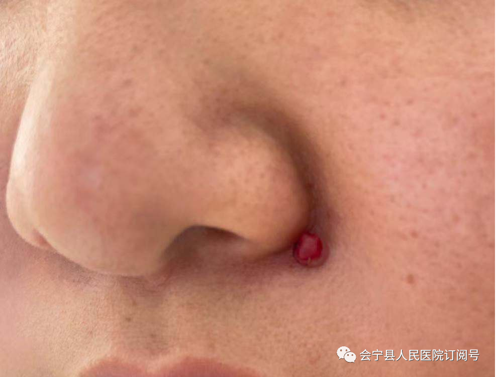 微波治疗机怎么使用【医学科普】微波手术治疗机可以治疗哪些常见皮肤病？_https://www.jmylbn.com_新闻资讯_第7张