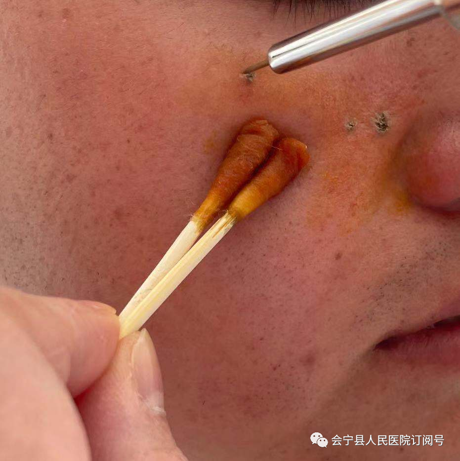 微波治疗机怎么使用【医学科普】微波手术治疗机可以治疗哪些常见皮肤病？_https://www.jmylbn.com_新闻资讯_第6张