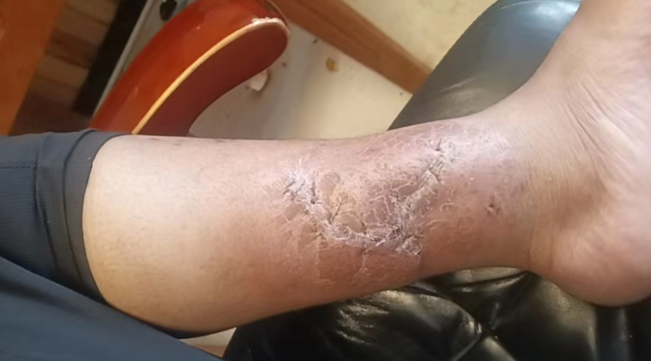 动物门诊用什么x光机青海小伙慕名至甘肃省第二人民医院动物咬伤门诊解“蛇”毒_https://www.jmylbn.com_新闻资讯_第7张